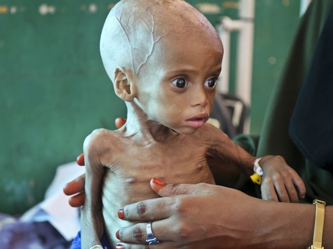Acutely malnourished child Sacdiyo Mohamed, 9 months old, is treated at Banadir hospital in Somalia on Saturday. Somalia's government has declared the drought there a national disaster.